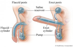 penile implant surgery works